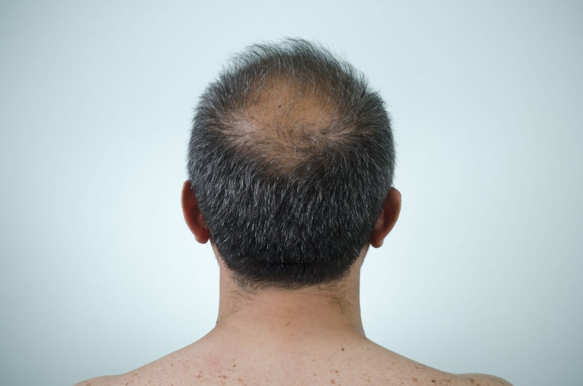 Hair Loss Prevention Tips: Strategies for Healthy and Strong Hair