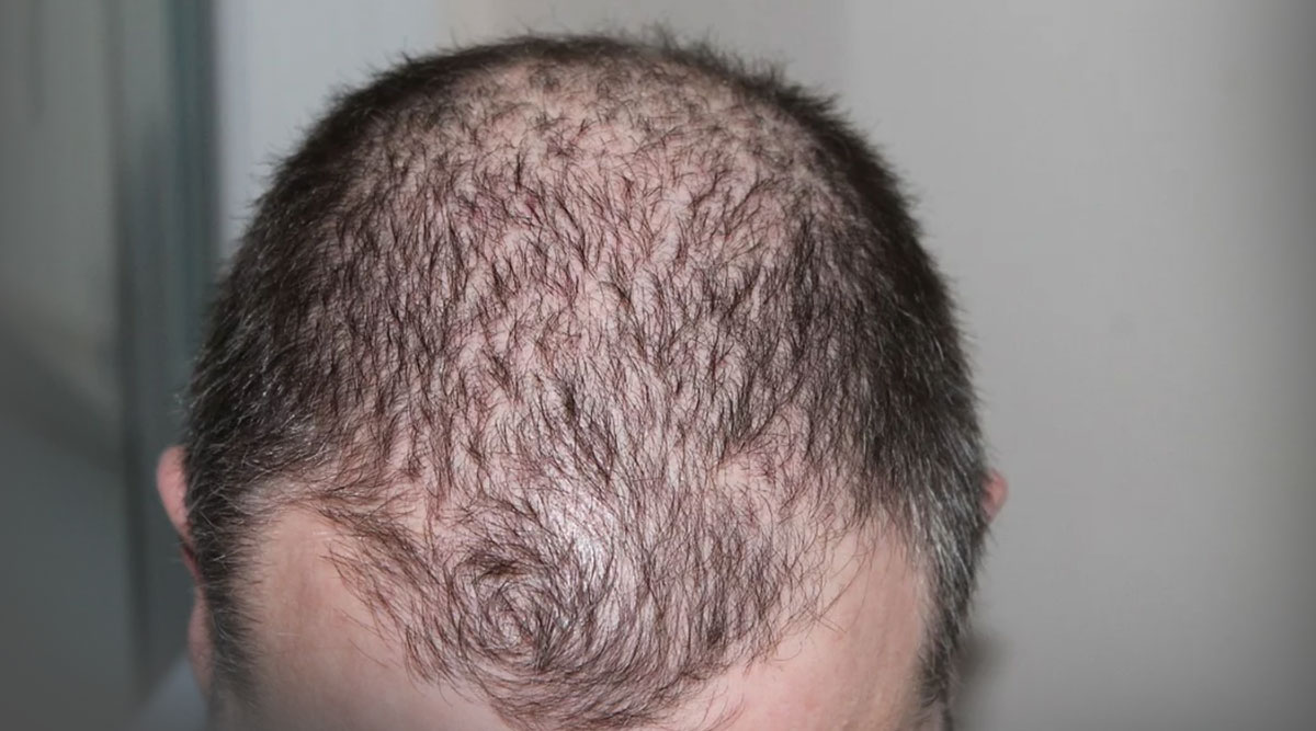 Iron deficiency hair loss