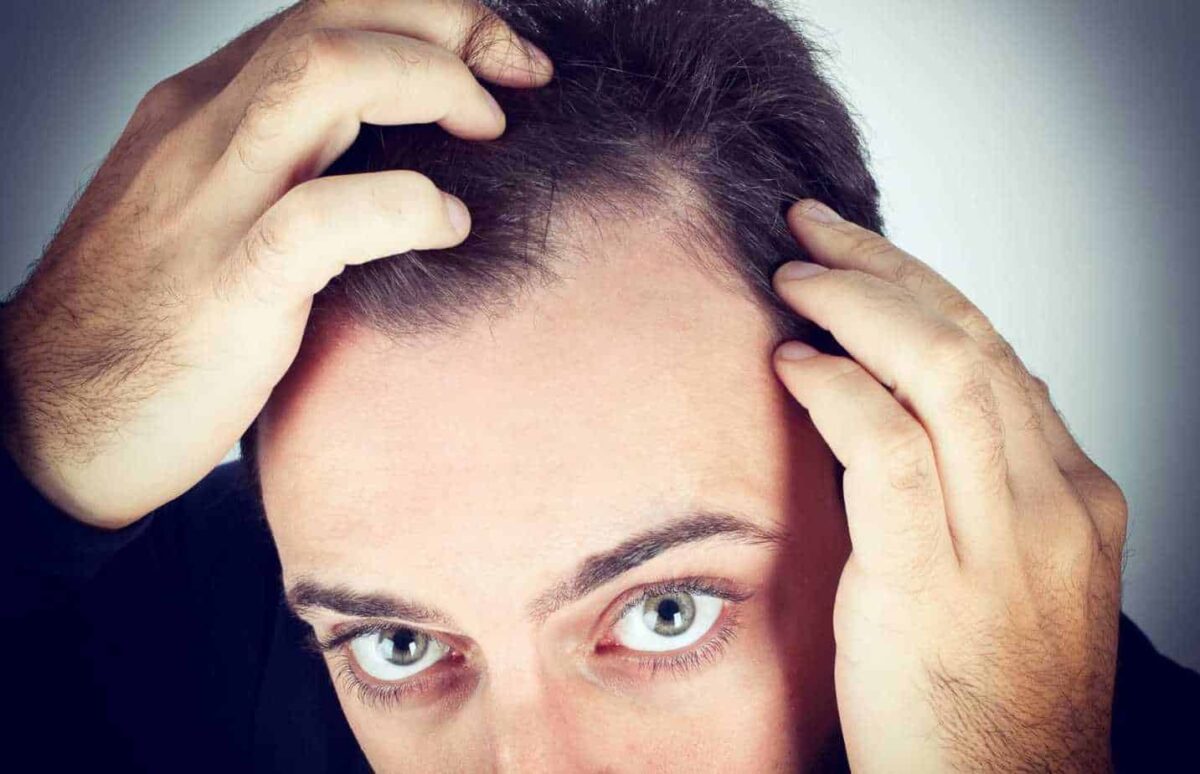 How to Prevent Hair Loss While Taking Testosterone