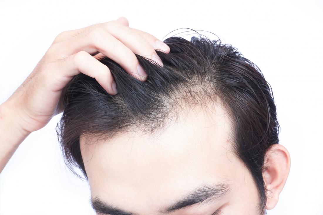 Can Vitamin Deficiency Cause Hair Loss?