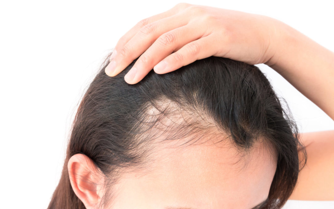 Which Vitamin Deficiency Causes Hair Loss?